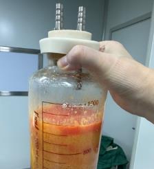 诸暨水动力吸脂手术要做多久？